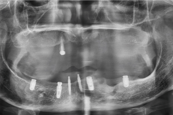 鈕扣式活動假牙術後X光片（吳小姐）