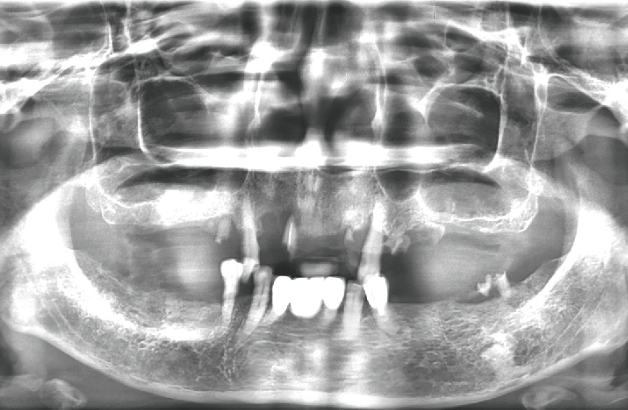 一日全口重建 All on 4 術前X光片（郭小姐）