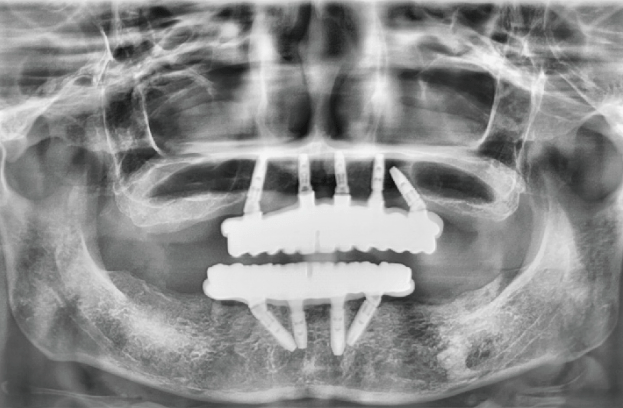 一日全口重建 All on 4 術後X光片（郭小姐）