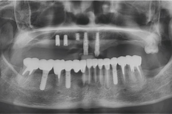 一日全口重建 All on 4 術前X光片（倪小姐）