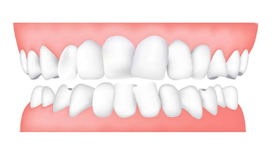 齒列擁擠：齒間縫隙不足，影響排列