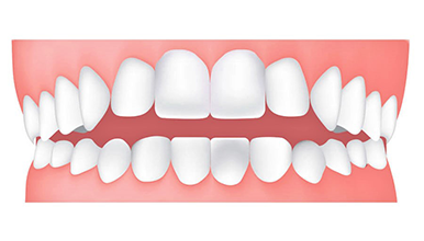 開咬：咬合時上排牙齒和下排牙齒無法碰在一起