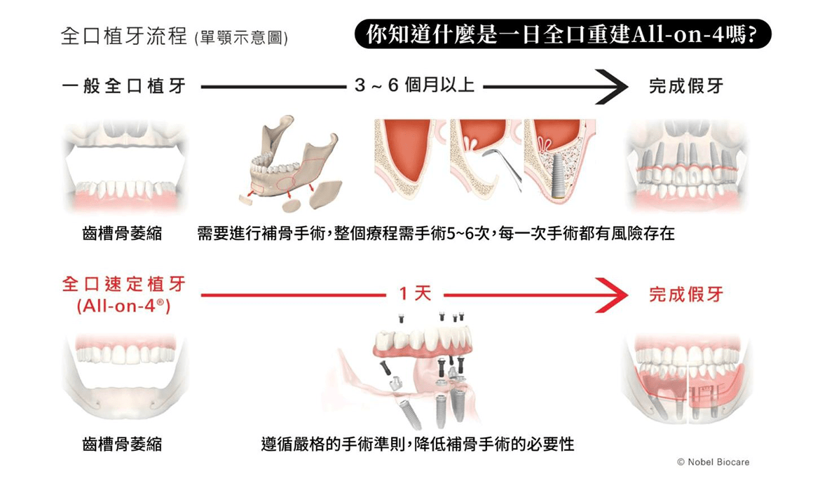 all on 4 一日全口重建