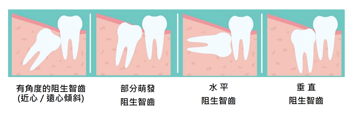 阻生智齒