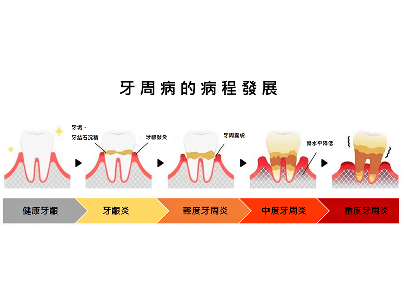 牙周病