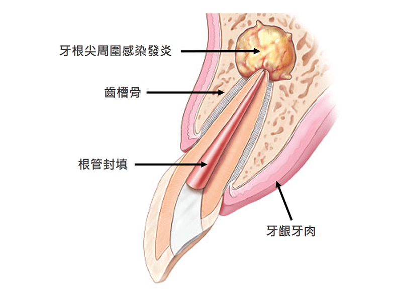 根尖切除手術流程