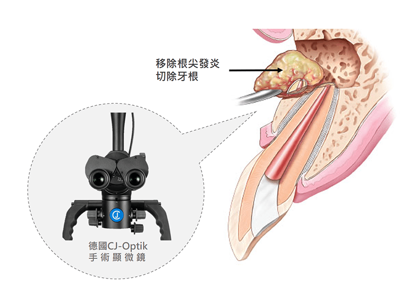 根尖切除手術