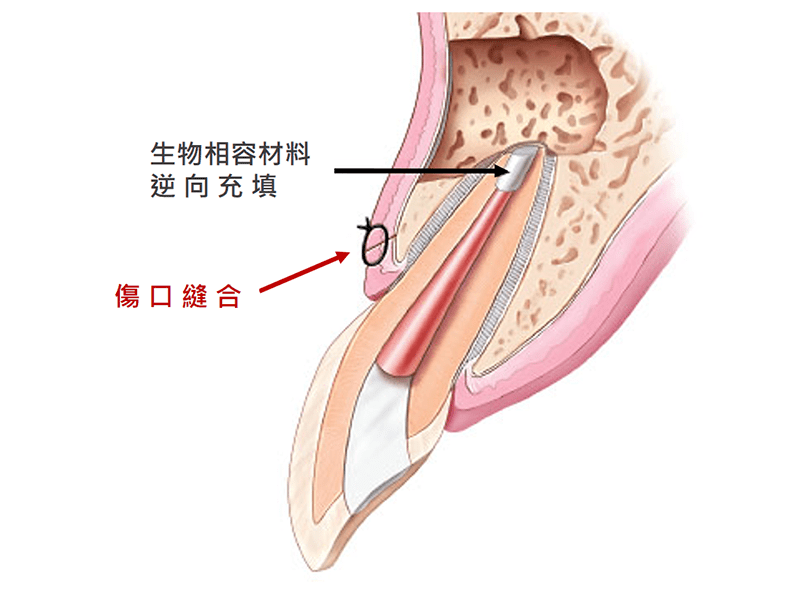 根尖切除手術流程