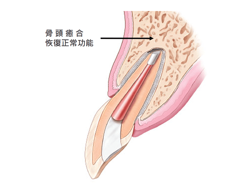 根尖切除手術流程